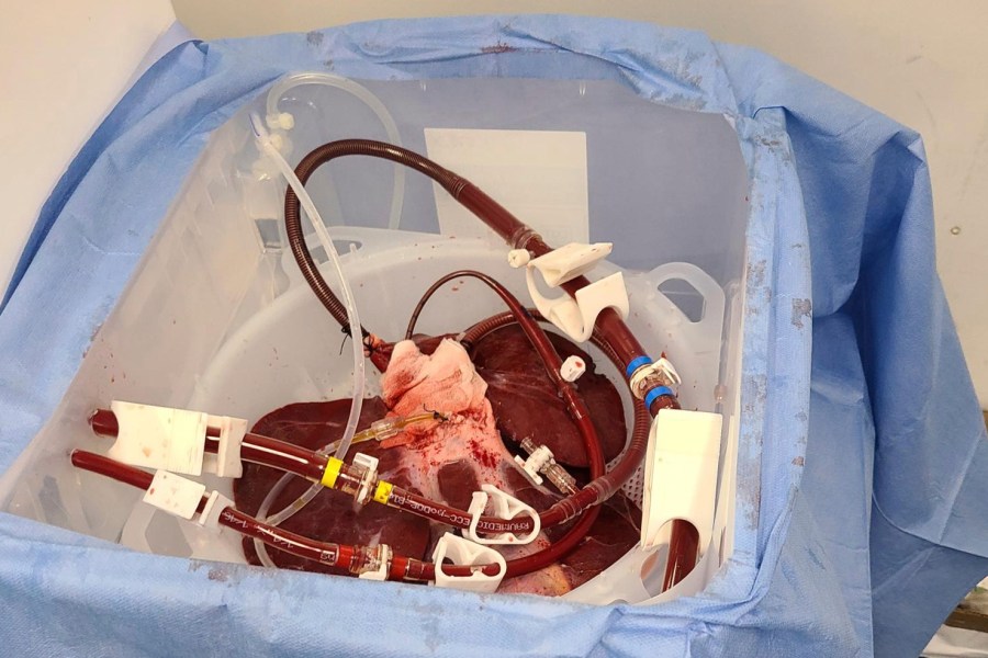 This photo provided by eGenesis on Jan. 18, 2024 shows a genetically modified pig liver in Massachusetts before transportation to the University of Pennsylvania in Philadelphia in December 2023. (eGenesis via AP)