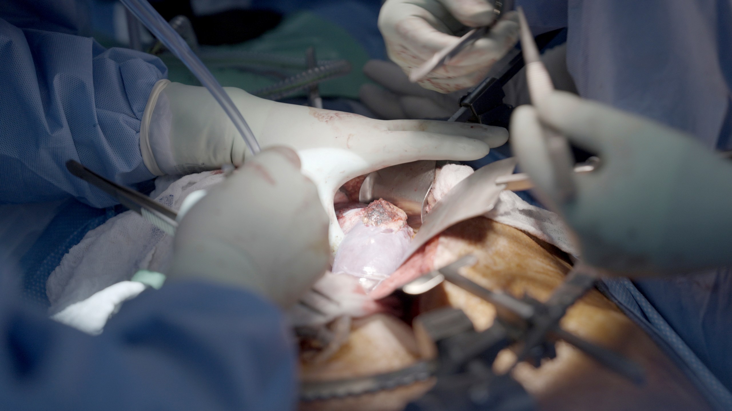 FILE - Surgeons remove a gene edited transplanted pig kidney from the body of Maurice "Mo" Miller at NYU Langone Health in New York, Sept. 13, 2023. (AP Photo/Shelby Lum, File)