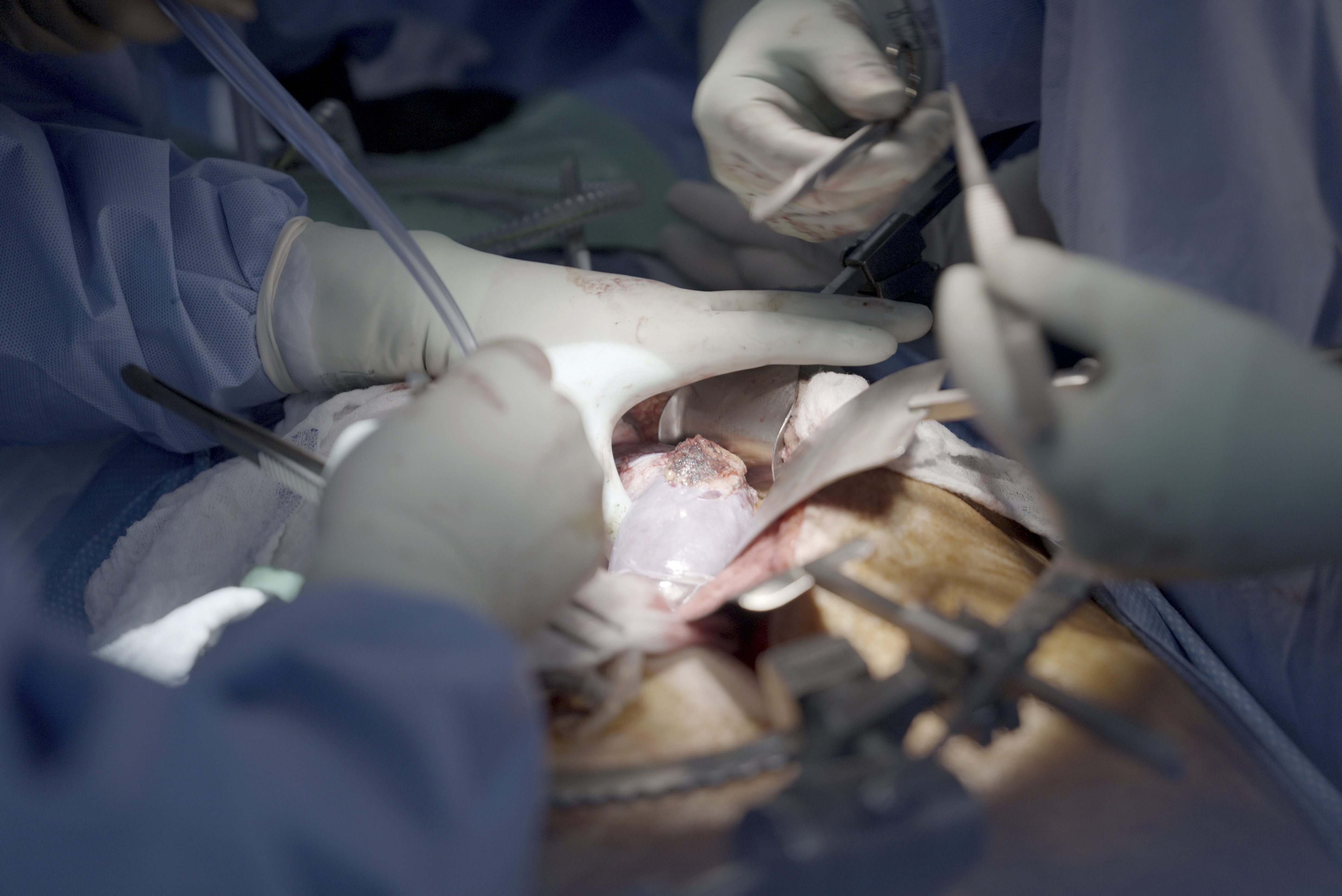 FILE - Surgeons remove a gene edited transplanted pig kidney from the body of Maurice "Mo" Miller at NYU Langone Health in New York, Sept. 13, 2023. (AP Photo/Shelby Lum, File)